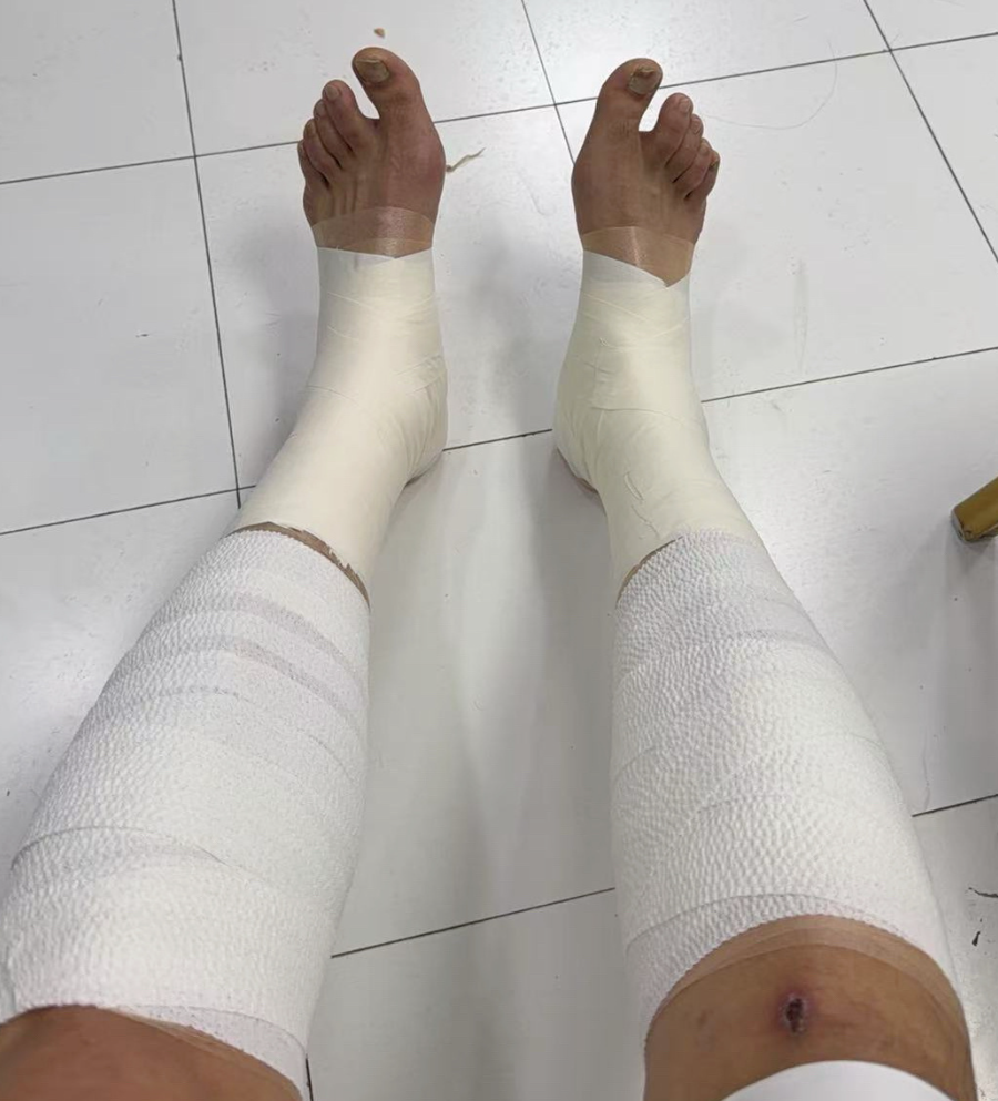 沙巴体育官方入口-胜山西谁注意翟晓川赛后伤势？双腿拉伤绑满绷带，看着都残忍！